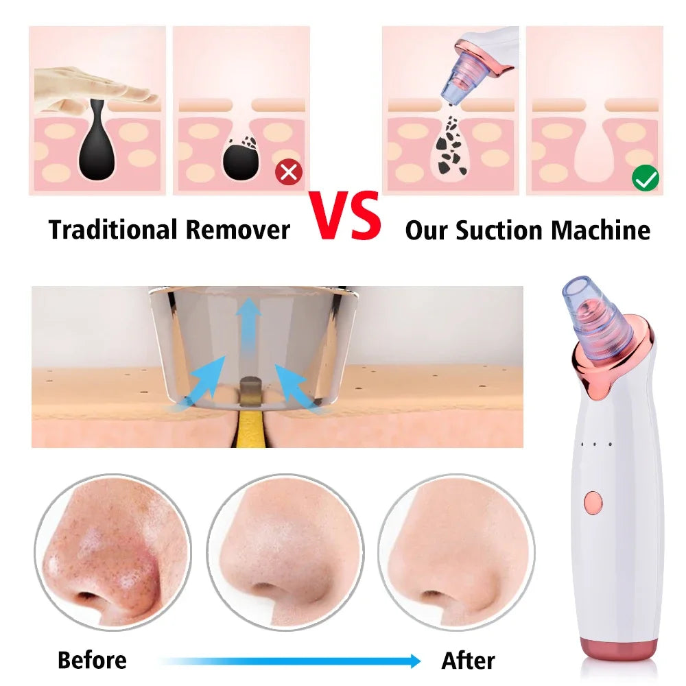 Electric Blackhead Remover & Pore Cleaner